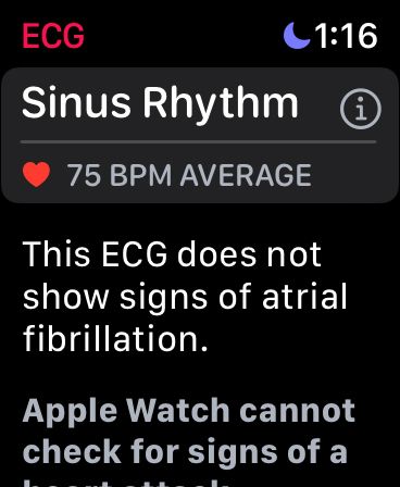 /nl/images/Apple-Watch-Tips-ECG.jpg